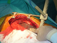 写真1:内胸動脈を採取