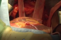 写真3:大伏在静脈を冠動脈に吻合