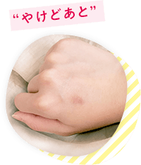 “やけどあと” 