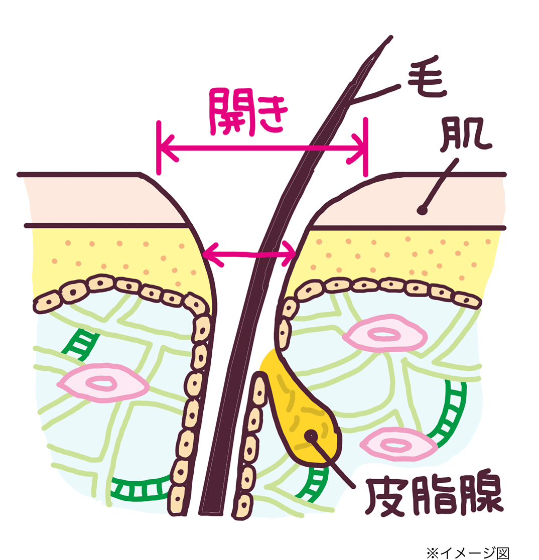 開き毛穴イメージ図