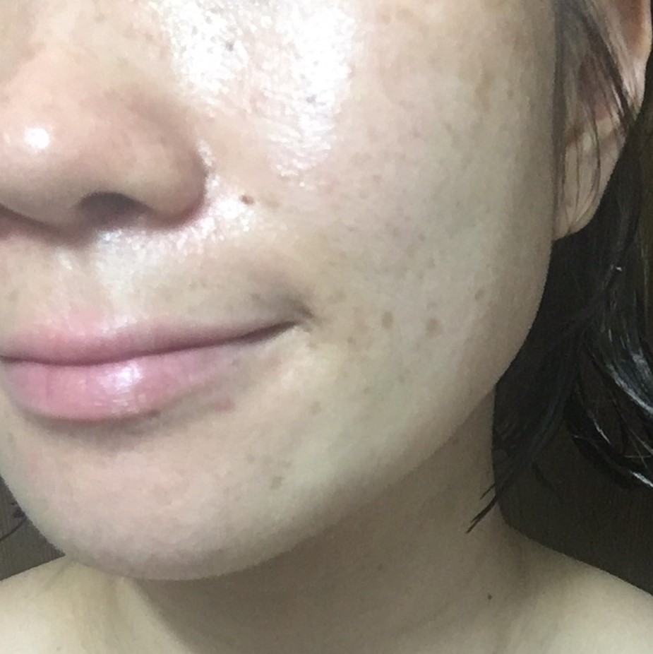 1週間後肌