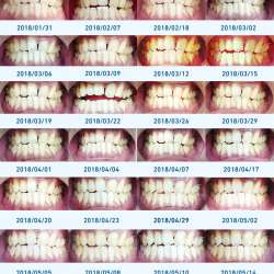 インビザライン歯列矯正ブログ  ブログサークル