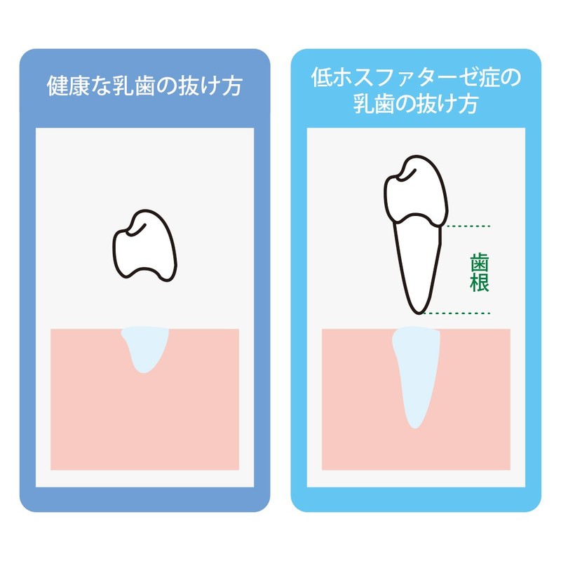 ファスターゼ　歯の抜け方