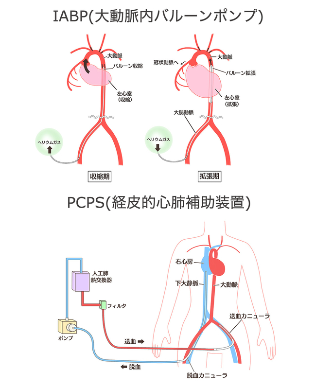 心臓機能の補助装置IABP・PCPS