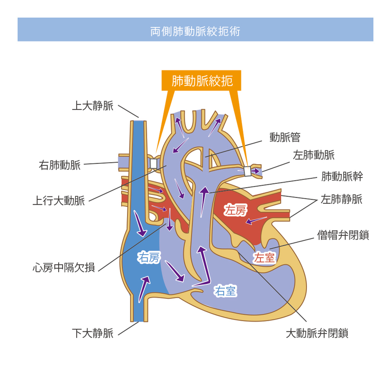 肺動脈絞扼術