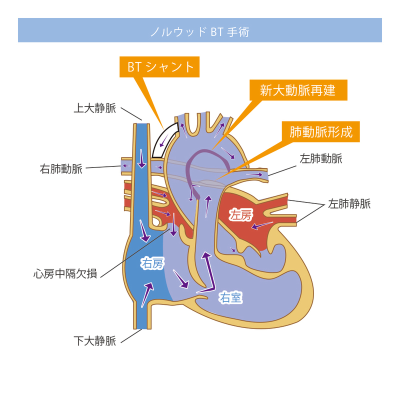 ノルウッドBT手術