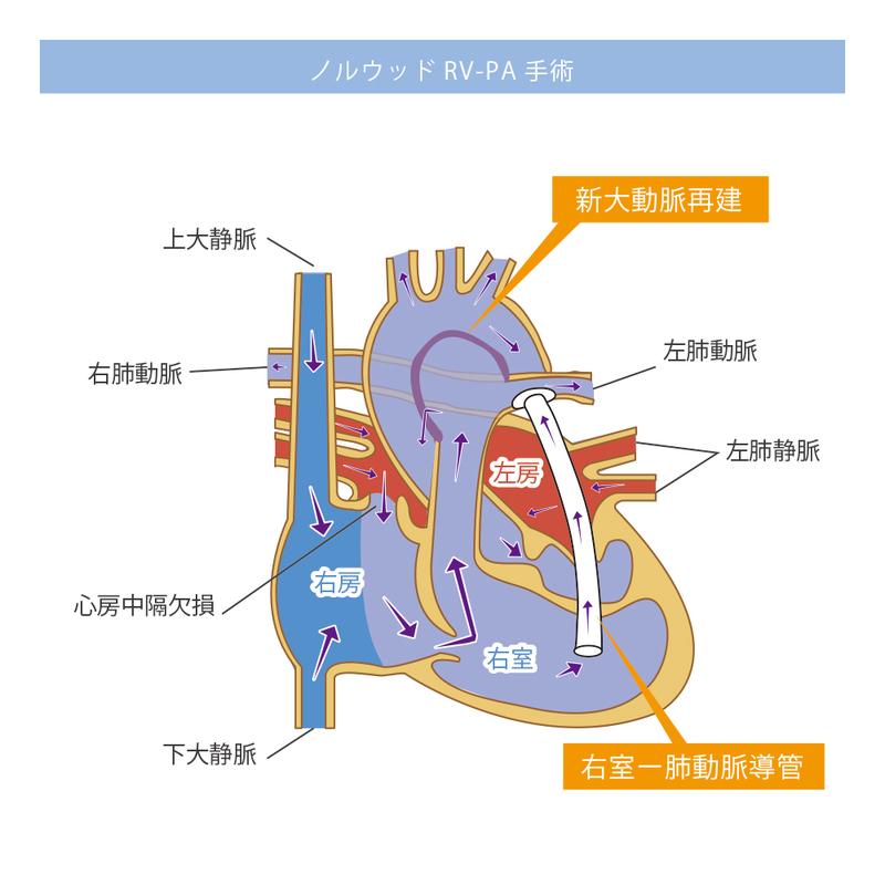 ノルウッドRV-PA手術