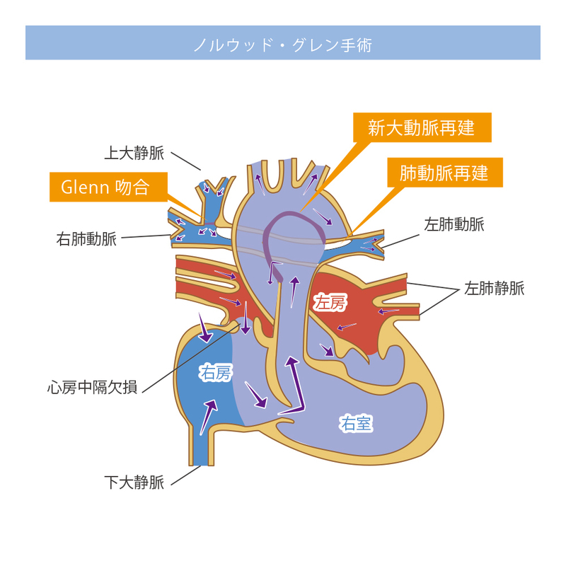 ノルウッド・グレン手術