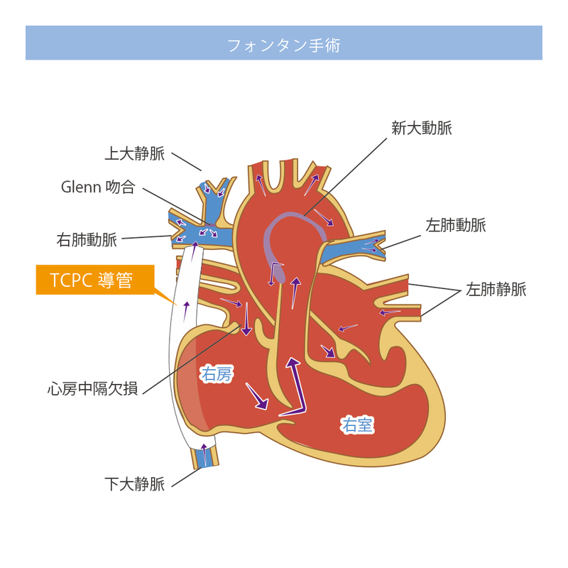 フォンタン手術