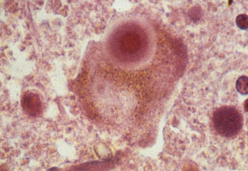 レビー小体　画像提供：望月秀樹先生