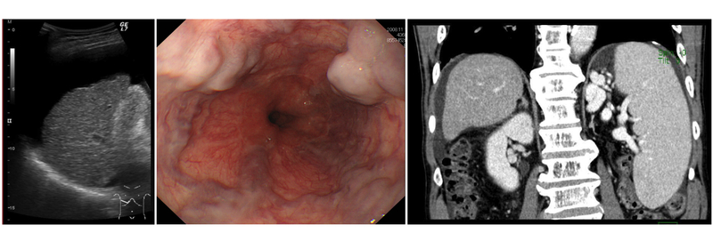 門脈圧亢進症の検査