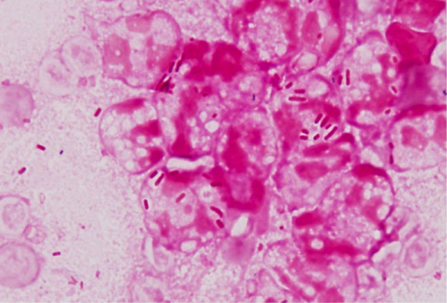 下痢便のグラム染色所見