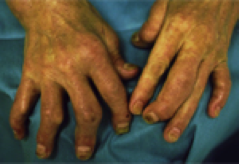 乾癬性関節炎（関節症性乾癬）