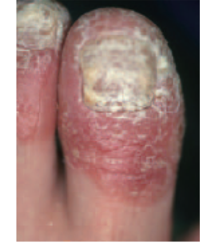 尋常性乾癬の爪病変