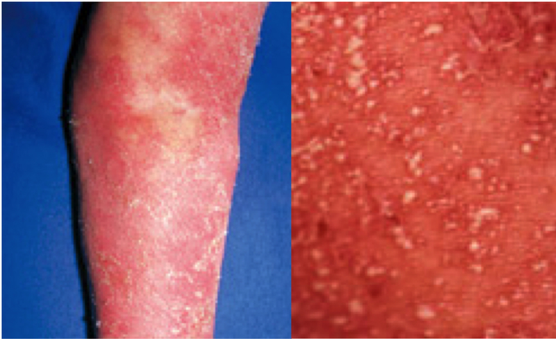 汎発性膿疱性乾癬