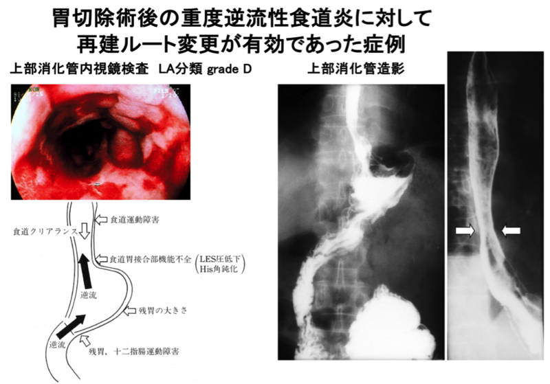 切除術後の消化管運動異常の症例