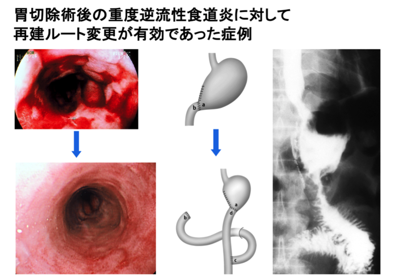 胃切除術後の消化管運動異常の症例2