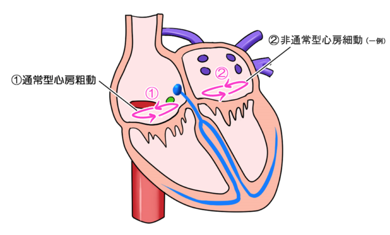 心房粗動の種類