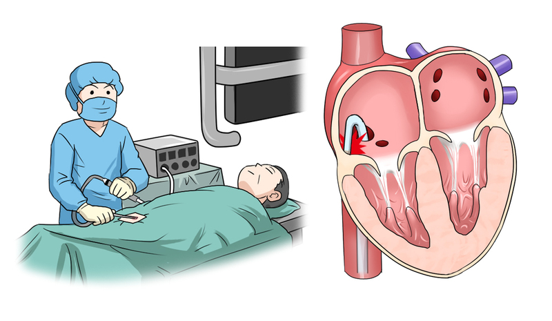 カテーテルアブレーションの適応