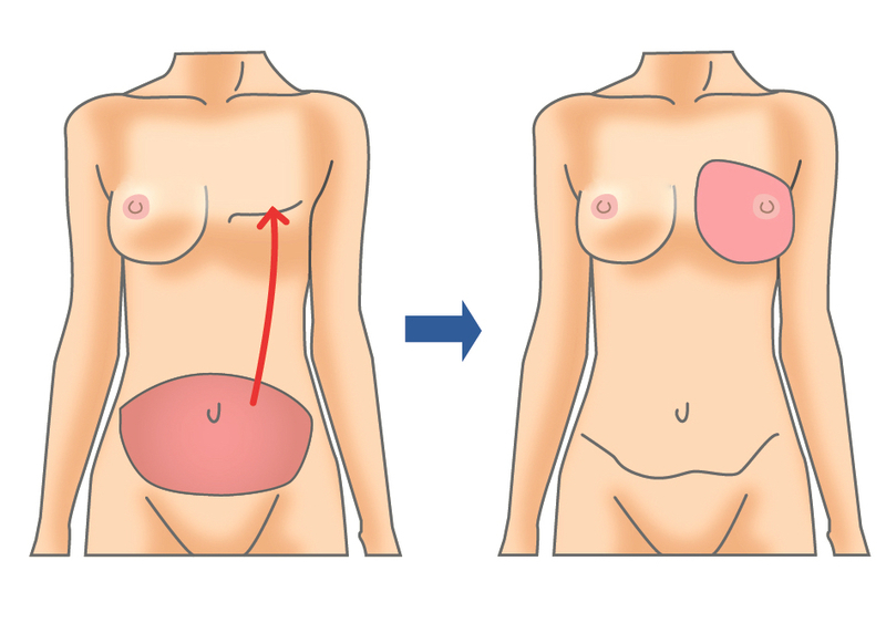 腹部の組織を使用する乳房再建術