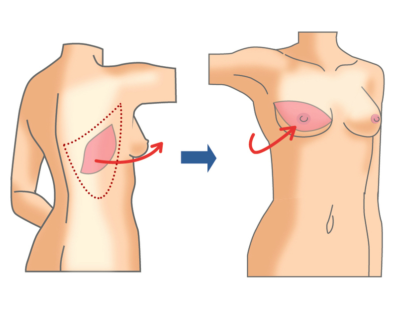 背中の組織を使用する乳房再建術