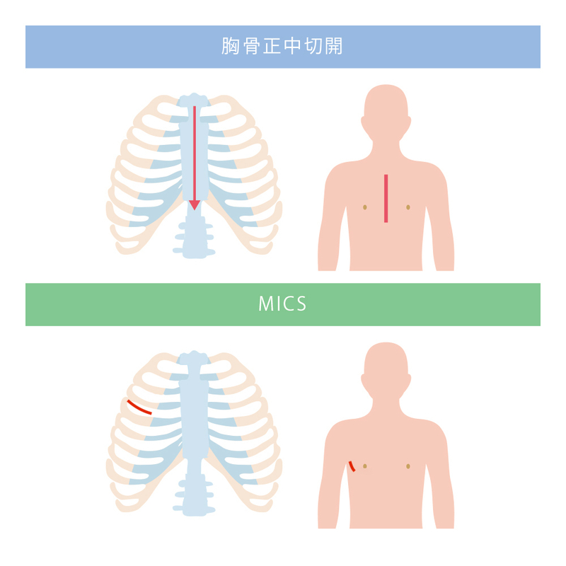 胸骨正中切開とMICS