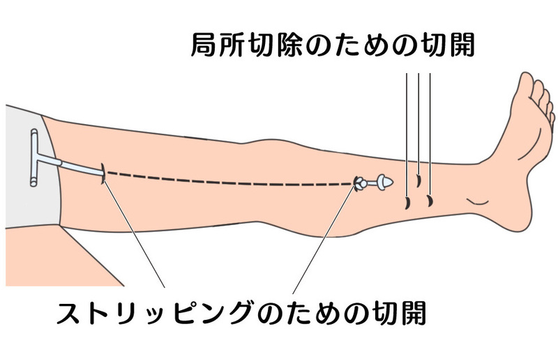 ストリッピング手術