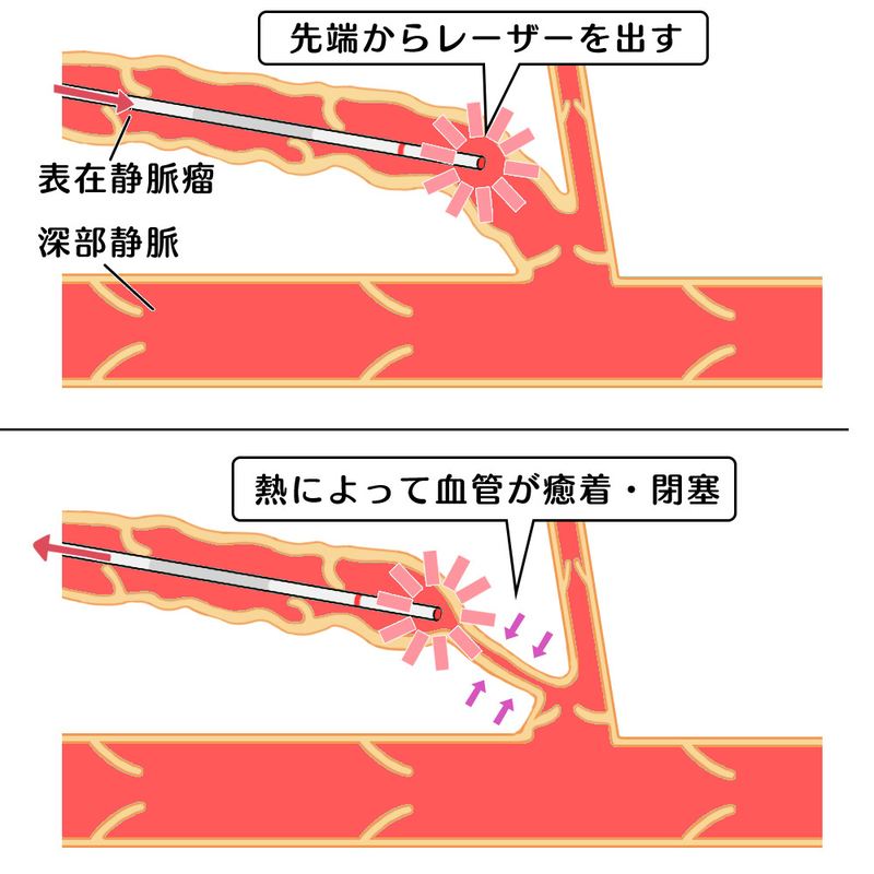 血管内レーザー焼灼術