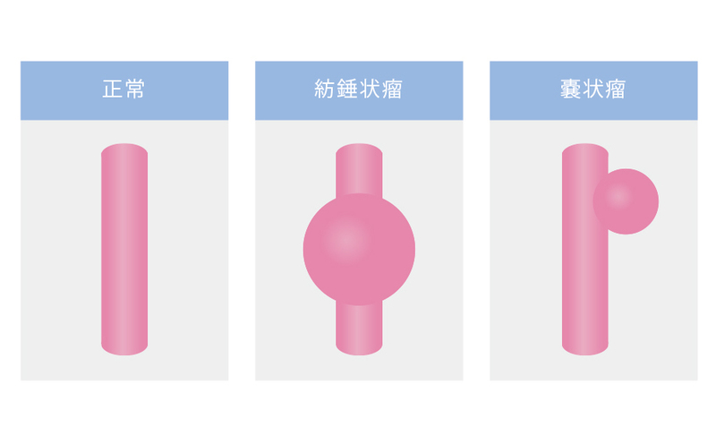 正常な大動脈と紡錘状瘤と嚢状瘤
