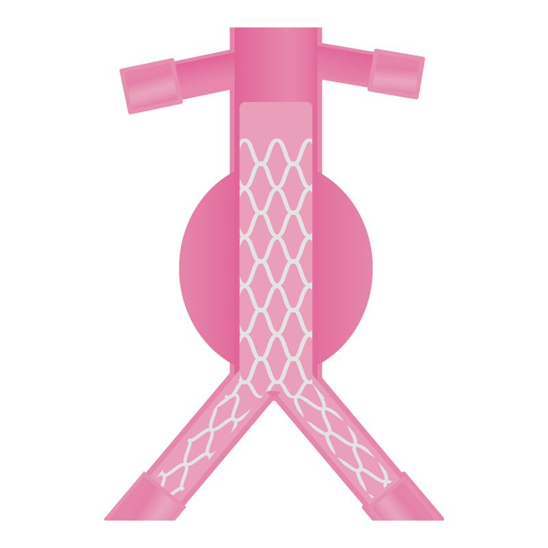 ステントグラフト挿入術後のイメージ