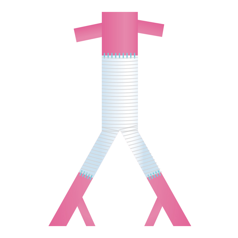 人工血管置換術後のイメージ
