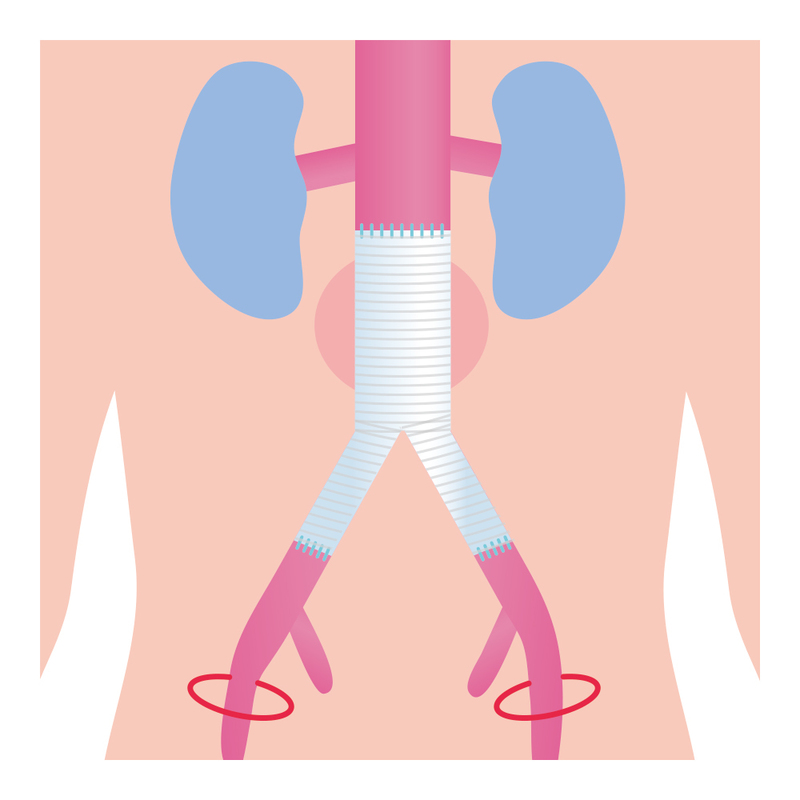 ステントグラフト挿入術の傷跡は2箇所