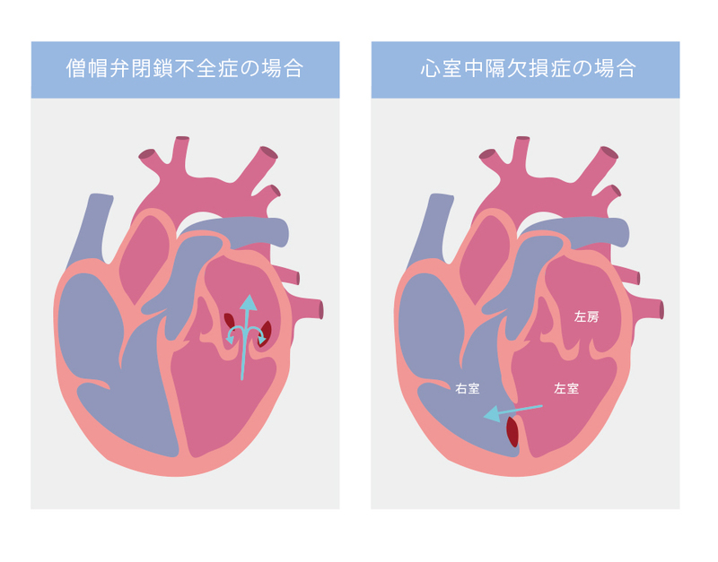 先天性心疾患や心臓弁膜症・心室中隔欠損症