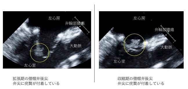 感染性心内膜炎の画像