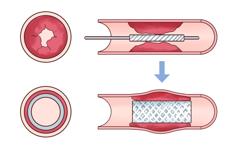 カテーテル治療とは？ その成り立ちと進歩 メディカルノート