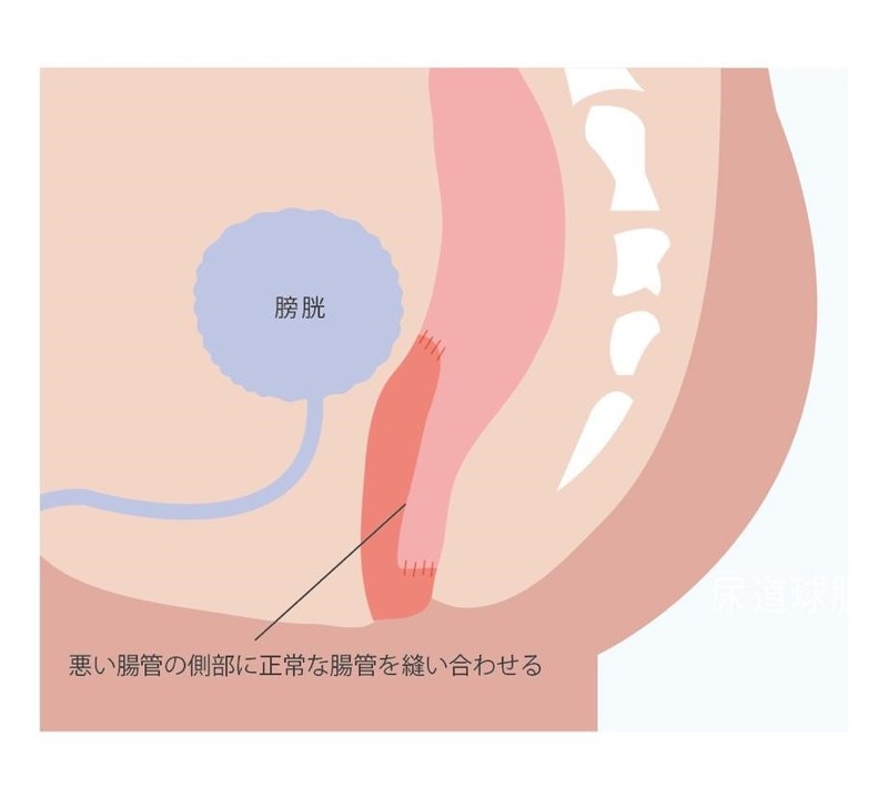 デュファメル法