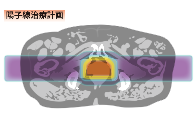 陽子線の治療計画