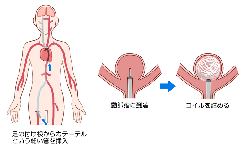 血管内コイル塞栓術