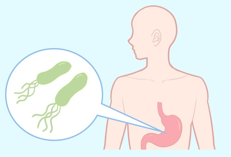 胃がん　ピロリ菌