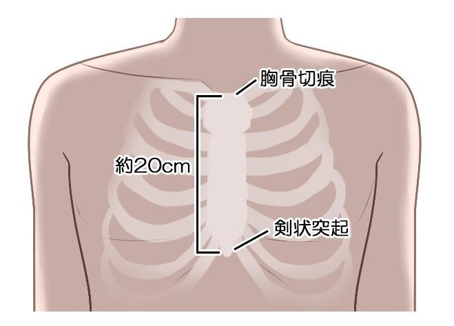  胸骨正中切開、人工心肺の確立