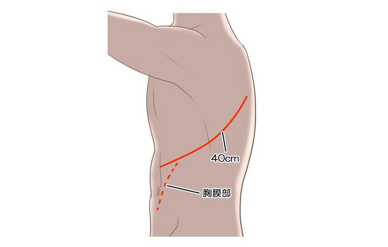 下行大動脈人工血管置換術の流れ
