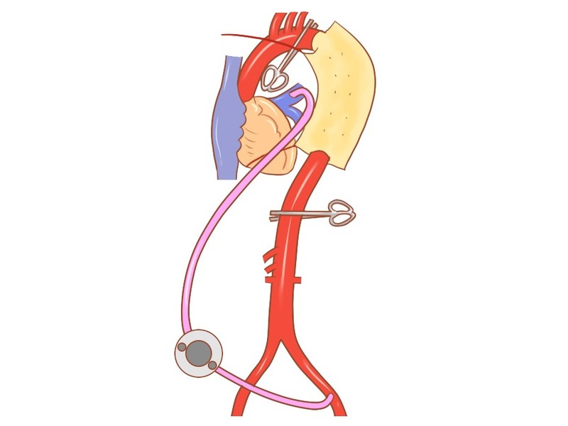 人工血管を縫合