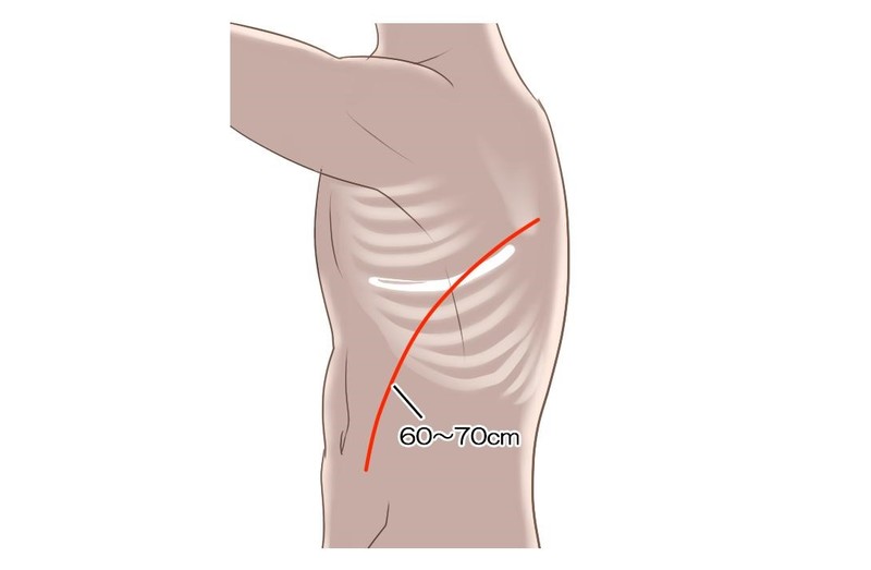 胸腹部大動脈人工血管置換術の流れ