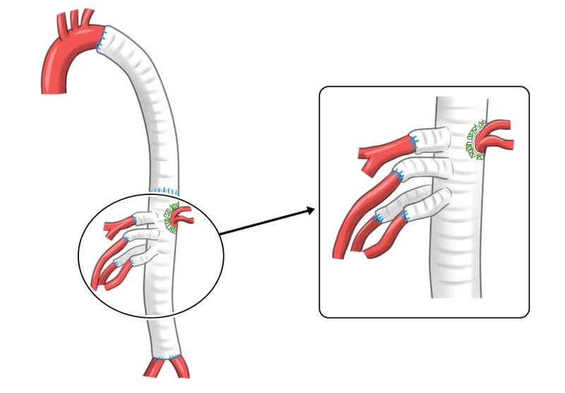 動脈瘤の切除、人口血管の再建