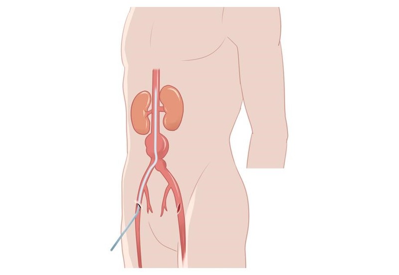 ステントグラフト内挿入