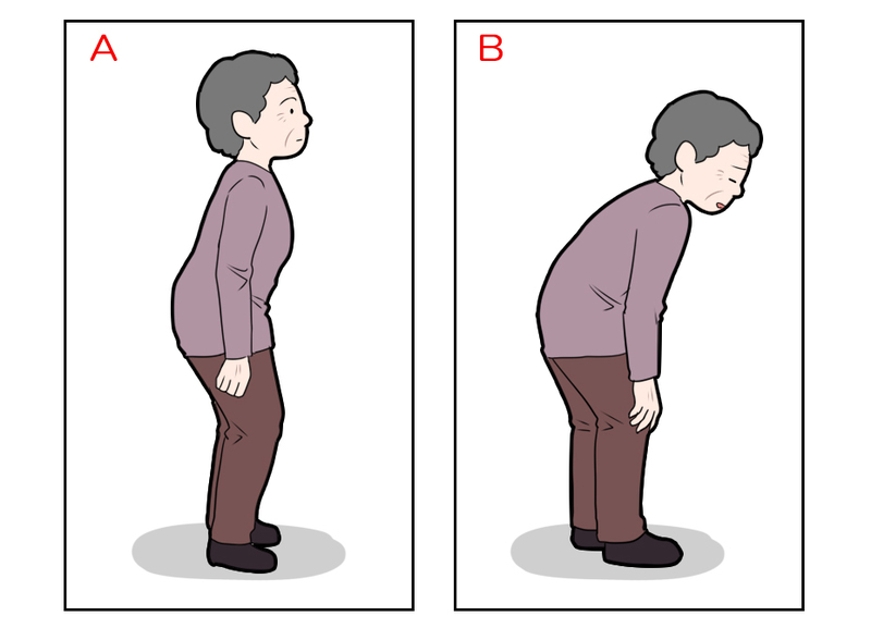 変性後側弯症に伴う典型的な姿勢
