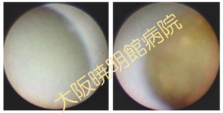 正常大動脈内壁、Puff-chandelier(パフ・シャンデリア)タイプのプラーク破綻