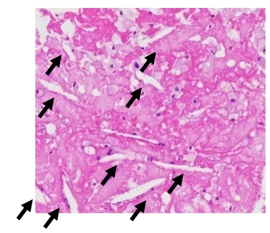 アテローマ内の空洞となったコレステロール結晶