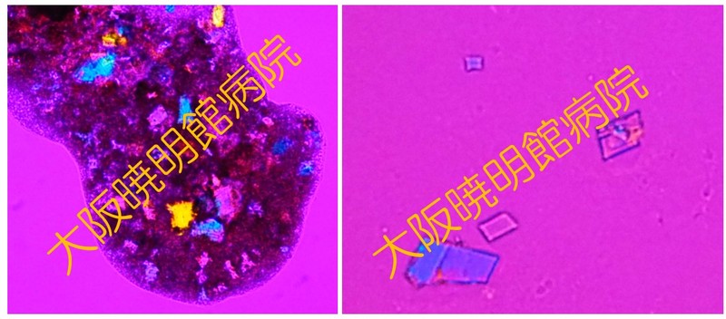 アテローマ内の偏光顕微鏡像、遊離したコレステロール結晶