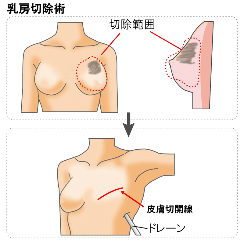 乳房切除術とは 手術の流れや術後について メディカルノート